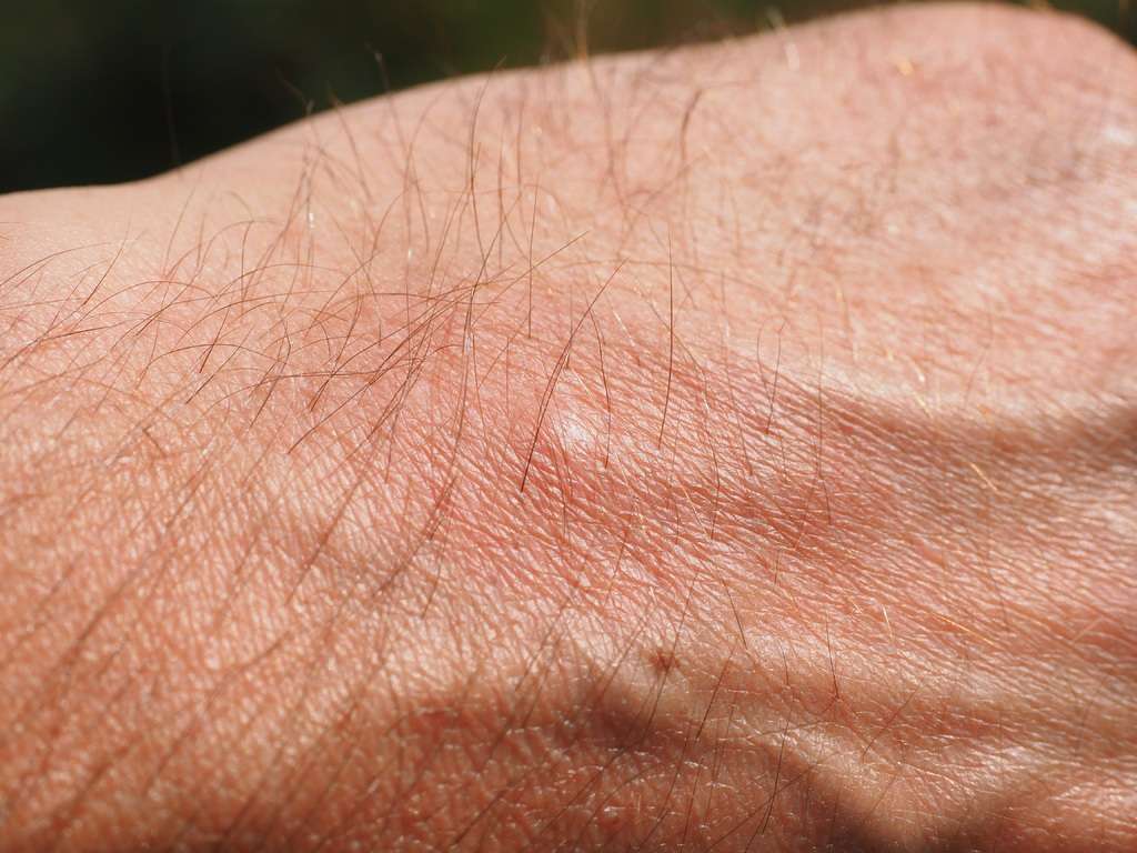 Piqures de moustiques